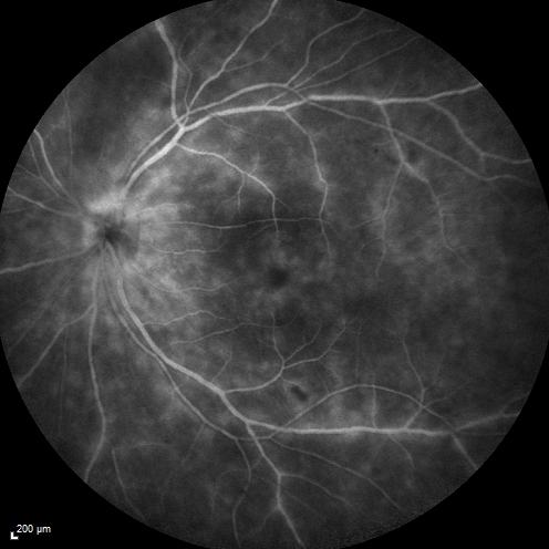 Birdshot Chorioretintis and PAMM
Patient presented with paracentral acute middle maculopathy as the presenting symptom of birdshot.  This case was published. RETINAL CASES & BRIEF REPORTS 10:151â€“153, 2016.
