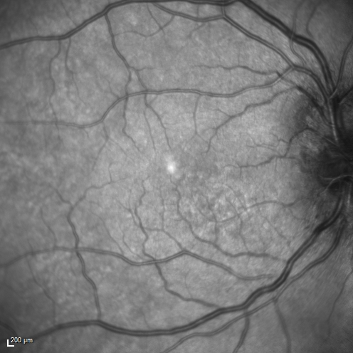 Syphillitic Optic Neuropathy and Maculopathy
46 year old woman with 2 weeks of vision loss OD.  VA 20/200 OD; 20/20 OS.  there are posterior vitreous cells on OCT in both eyes.  ICG, FAF, and FA show an abnormal macula OD.  VA improved to 20/30 within a month with treatment with PCN.
Keywords: syphillis