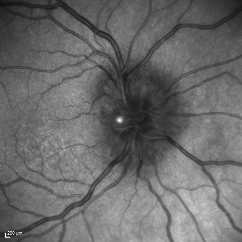 Syphillitic Optic Neuropathy and Maculopathy
46 year old woman with 2 weeks of vision loss OD.  VA 20/200 OD; 20/20 OS.  there are posterior vitreous cells on OCT in both eyes.  ICG, FAF, and FA show an abnormal macula OD.  VA improved to 20/30 within a month with treatment with PCN.
Keywords: syphillis