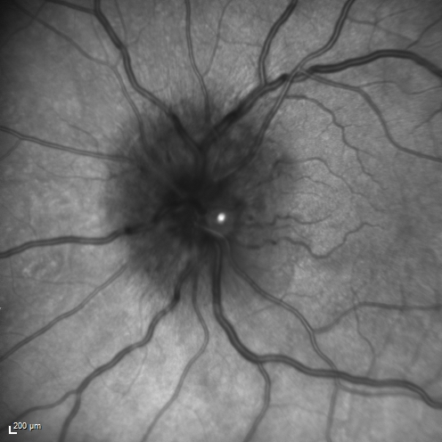 Syphillitic Optic Neuropathy and Maculopathy
46 year old woman with 2 weeks of vision loss OD.  VA 20/200 OD; 20/20 OS.  there are posterior vitreous cells on OCT in both eyes.  ICG, FAF, and FA show an abnormal macula OD.  VA improved to 20/30 within a month with treatment with PCN.
Keywords: syphillis