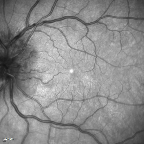 Syphillitic Optic Neuropathy and Maculopathy
46 year old woman with 2 weeks of vision loss OD.  VA 20/200 OD; 20/20 OS.  there are posterior vitreous cells on OCT in both eyes.  ICG, FAF, and FA show an abnormal macula OD.  VA improved to 20/30 within a month with treatment with PCN.
Keywords: syphillis