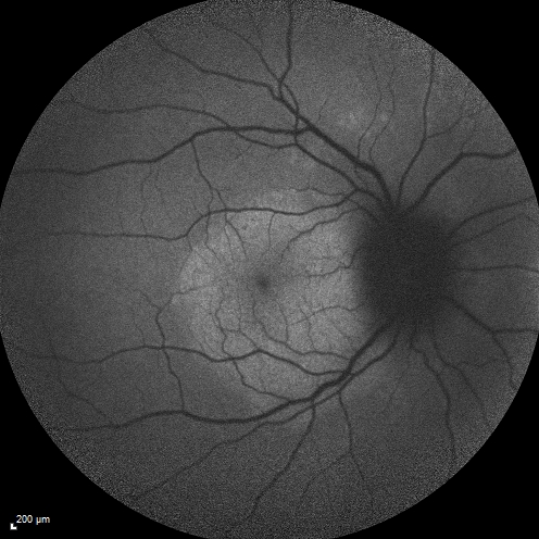 Syphillitic Optic Neuropathy and Maculopathy
46 year old woman with 2 weeks of vision loss OD.  VA 20/200 OD; 20/20 OS.  there are posterior vitreous cells on OCT in both eyes.  ICG, FAF, and FA show an abnormal macula OD.  VA improved to 20/30 within a month with treatment with PCN.
Keywords: syphillis