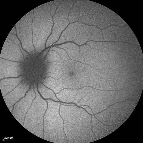 Syphillitic Optic Neuropathy and Maculopathy
46 year old woman with 2 weeks of vision loss OD.  VA 20/200 OD; 20/20 OS.  there are posterior vitreous cells on OCT in both eyes.  ICG, FAF, and FA show an abnormal macula OD.  VA improved to 20/30 within a month with treatment with PCN.
Keywords: syphillis
