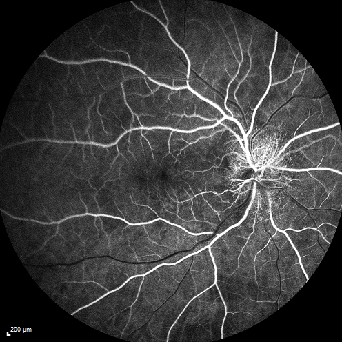 Syphillitic Optic Neuropathy and Maculopathy
46 year old woman with 2 weeks of vision loss OD.  VA 20/200 OD; 20/20 OS.  there are posterior vitreous cells on OCT in both eyes.  ICG, FAF, and FA show an abnormal macula OD.  VA improved to 20/30 within a month with treatment with PCN.
Keywords: syphillis