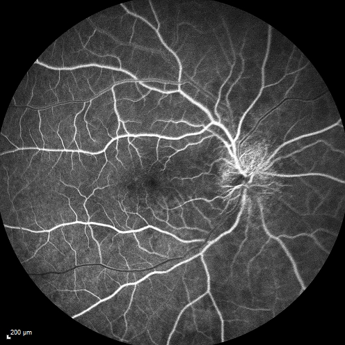 Syphillitic Optic Neuropathy and Maculopathy
46 year old woman with 2 weeks of vision loss OD.  VA 20/200 OD; 20/20 OS.  there are posterior vitreous cells on OCT in both eyes.  ICG, FAF, and FA show an abnormal macula OD.  VA improved to 20/30 within a month with treatment with PCN.
Keywords: syphillis