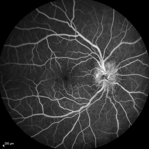 Syphillitic Optic Neuropathy and Maculopathy
46 year old woman with 2 weeks of vision loss OD.  VA 20/200 OD; 20/20 OS.  there are posterior vitreous cells on OCT in both eyes.  ICG, FAF, and FA show an abnormal macula OD.  VA improved to 20/30 within a month with treatment with PCN.
Keywords: syphillis