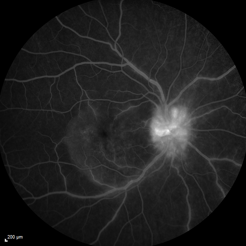 Syphillitic Optic Neuropathy and Maculopathy
46 year old woman with 2 weeks of vision loss OD.  VA 20/200 OD; 20/20 OS.  there are posterior vitreous cells on OCT in both eyes.  ICG, FAF, and FA show an abnormal macula OD.  VA improved to 20/30 within a month with treatment with PCN.
Keywords: syphillis