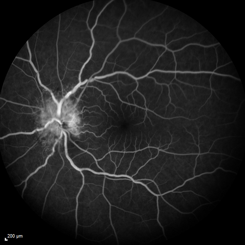 Syphillitic Optic Neuropathy and Maculopathy
46 year old woman with 2 weeks of vision loss OD.  VA 20/200 OD; 20/20 OS.  there are posterior vitreous cells on OCT in both eyes.  ICG, FAF, and FA show an abnormal macula OD.  VA improved to 20/30 within a month with treatment with PCN.
Keywords: syphillis