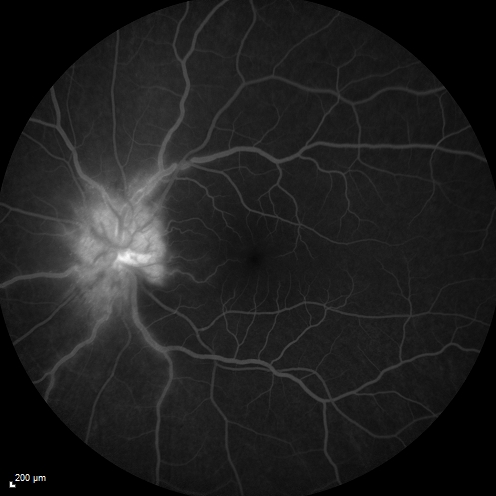Syphillitic Optic Neuropathy and Maculopathy
46 year old woman with 2 weeks of vision loss OD.  VA 20/200 OD; 20/20 OS.  there are posterior vitreous cells on OCT in both eyes.  ICG, FAF, and FA show an abnormal macula OD.  VA improved to 20/30 within a month with treatment with PCN.
Keywords: syphillis