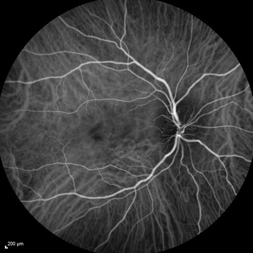 Syphillitic Optic Neuropathy and Maculopathy
46 year old woman with 2 weeks of vision loss OD.  VA 20/200 OD; 20/20 OS.  there are posterior vitreous cells on OCT in both eyes.  ICG, FAF, and FA show an abnormal macula OD.  VA improved to 20/30 within a month with treatment with PCN.
Keywords: syphillis