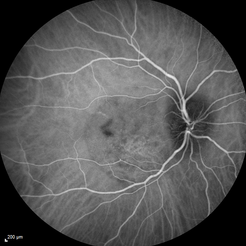 Syphillitic Optic Neuropathy and Maculopathy
46 year old woman with 2 weeks of vision loss OD.  VA 20/200 OD; 20/20 OS.  there are posterior vitreous cells on OCT in both eyes.  ICG, FAF, and FA show an abnormal macula OD.  VA improved to 20/30 within a month with treatment with PCN.
Keywords: syphillis