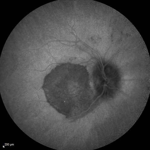 Syphillitic Optic Neuropathy and Maculopathy
46 year old woman with 2 weeks of vision loss OD.  VA 20/200 OD; 20/20 OS.  there are posterior vitreous cells on OCT in both eyes.  ICG, FAF, and FA show an abnormal macula OD.  VA improved to 20/30 within a month with treatment with PCN.
Keywords: syphillis