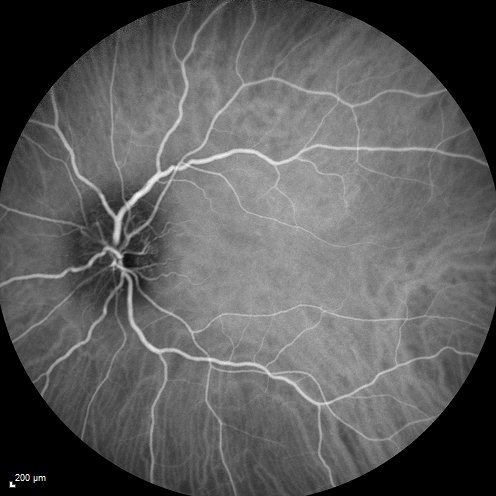 Syphillitic Optic Neuropathy and Maculopathy
46 year old woman with 2 weeks of vision loss OD.  VA 20/200 OD; 20/20 OS.  there are posterior vitreous cells on OCT in both eyes.  ICG, FAF, and FA show an abnormal macula OD.  VA improved to 20/30 within a month with treatment with PCN.
Keywords: syphillis