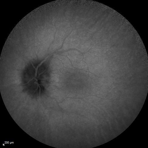 Syphillitic Optic Neuropathy and Maculopathy
46 year old woman with 2 weeks of vision loss OD.  VA 20/200 OD; 20/20 OS.  there are posterior vitreous cells on OCT in both eyes.  ICG, FAF, and FA show an abnormal macula OD.  VA improved to 20/30 within a month with treatment with PCN.
Keywords: syphillis