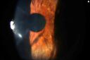 CRAO-NVI-Slit_lamp.jpg