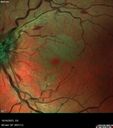 CRVO-cilioretinal-occlusion_117350_101623_04.jpg