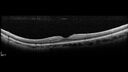 CRVO-cilioretinal-occlusion_117350_101623_08.jpg