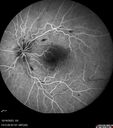 CRVO-cilioretinal-occlusion_117350_101623_17.jpg