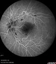 CRVO-cilioretinal-occlusion_117350_101623_18.jpg