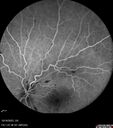 CRVO-cilioretinal-occlusion_117350_101623_19.jpg