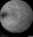 CRVO-cilioretinal-occlusion_117350_101623_21.jpg