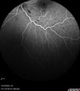 CRVO-cilioretinal-occlusion_117350_101623_22.jpg