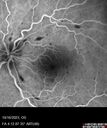 CRVO-cilioretinal-occlusion_117350_101623_25.jpg