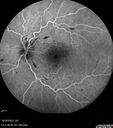CRVO-cilioretinal-occlusion_117350_101623_26.jpg