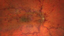 CRVO-non-ischemic-121875-1-092724_01.jpg