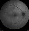 DR-Macular-Ischemia_126599_080825_05.jpg