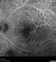 Filename=DR-Macular-Ischemia_126599_080825_09.jpg
Filesize=713KiB
Dimensions=1024x1124
Date added=Jan 11, 2026 DR-Macular-Ischemia_126599_080825_09.jpg