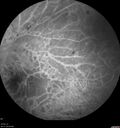 Filename=DR-Macular-Ischemia_126599_080825_13.jpg
Filesize=1383KiB
Dimensions=1536x1636
Date added=Jan 11, 2026 DR-Macular-Ischemia_126599_080825_13.jpg