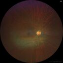 Filename=Dystrophy-genenegative_arfer_040821_02.jpg
Filesize=5694KiB
Dimensions=3916x3916
Date added=Oct 25, 2021 Dystrophy-genenegative_arfer_040821_02.jpg