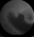 Dystrophy-genenegative_arfer_040821_19.jpg