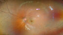 Filename=Hemangioma_124395_032025_02.jpg
Filesize=3132KiB
Dimensions=2712x1526
Date added=Aug 13, 2025 Hemangioma_124395_032025_02.jpg