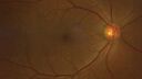 Filename=Idiopathic-CNVM_081221_anvir_01.jpg
Filesize=241KiB
Dimensions=2032x1143
Date added=Aug 19, 2021 Idiopathic-CNVM_081221_anvir_01.jpg