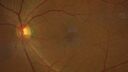 Filename=Idiopathic-CNVM_081221_anvir_02.jpg
Filesize=196KiB
Dimensions=1733x975
Date added=Aug 19, 2021 Idiopathic-CNVM_081221_anvir_02.jpg