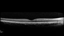 Filename=Idiopathic-CNVM_081221_anvir_03.jpg
Filesize=175KiB
Dimensions=1536x864
Date added=Aug 19, 2021 Idiopathic-CNVM_081221_anvir_03.jpg