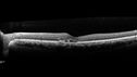 Filename=Idiopathic-CNVM_081221_anvir_05.jpg
Filesize=144KiB
Dimensions=1444x812
Date added=Aug 19, 2021 Idiopathic-CNVM_081221_anvir_05.jpg