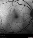 Filename=Idiopathic-CNVM_081221_anvir_06.jpg
Filesize=116KiB
Dimensions=768x868
Date added=Aug 19, 2021 Idiopathic-CNVM_081221_anvir_06.jpg