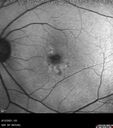 Filename=Idiopathic-CNVM_081221_anvir_07.jpg
Filesize=130KiB
Dimensions=768x868
Date added=Aug 19, 2021 Idiopathic-CNVM_081221_anvir_07.jpg