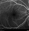 Filename=Idiopathic-CNVM_081221_anvir_08.jpg
Filesize=241KiB
Dimensions=1536x1636
Date added=Aug 19, 2021 Idiopathic-CNVM_081221_anvir_08.jpg