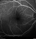 Filename=Idiopathic-CNVM_081221_anvir_09.jpg
Filesize=166KiB
Dimensions=1536x1636
Date added=Aug 19, 2021 Idiopathic-CNVM_081221_anvir_09.jpg