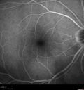 Filename=Idiopathic-CNVM_081221_anvir_10.jpg
Filesize=345KiB
Dimensions=1536x1636
Date added=Aug 19, 2021 Idiopathic-CNVM_081221_anvir_10.jpg