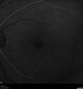 Filename=Idiopathic-CNVM_081221_anvir_11.jpg
Filesize=363KiB
Dimensions=1536x1636
Date added=Aug 19, 2021 Idiopathic-CNVM_081221_anvir_11.jpg
