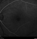Filename=Idiopathic-CNVM_081221_anvir_12.jpg
Filesize=388KiB
Dimensions=1536x1636
Date added=Aug 19, 2021 Idiopathic-CNVM_081221_anvir_12.jpg
