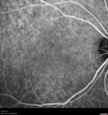 Idiopathic-CNVM_081221_anvir_20.jpg