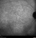 Filename=Idiopathic-CNVM_081221_anvir_21.jpg
Filesize=514KiB
Dimensions=1536x1636
Date added=Aug 19, 2021 Idiopathic-CNVM_081221_anvir_21.jpg