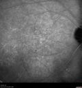 Filename=Idiopathic-CNVM_081221_anvir_22.jpg
Filesize=487KiB
Dimensions=1536x1636
Date added=Aug 19, 2021 Idiopathic-CNVM_081221_anvir_22.jpg