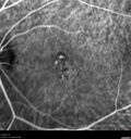 Filename=Idiopathic-CNVM_081221_anvir_23.jpg
Filesize=278KiB
Dimensions=1536x1636
Date added=Aug 19, 2021 Idiopathic-CNVM_081221_anvir_23.jpg